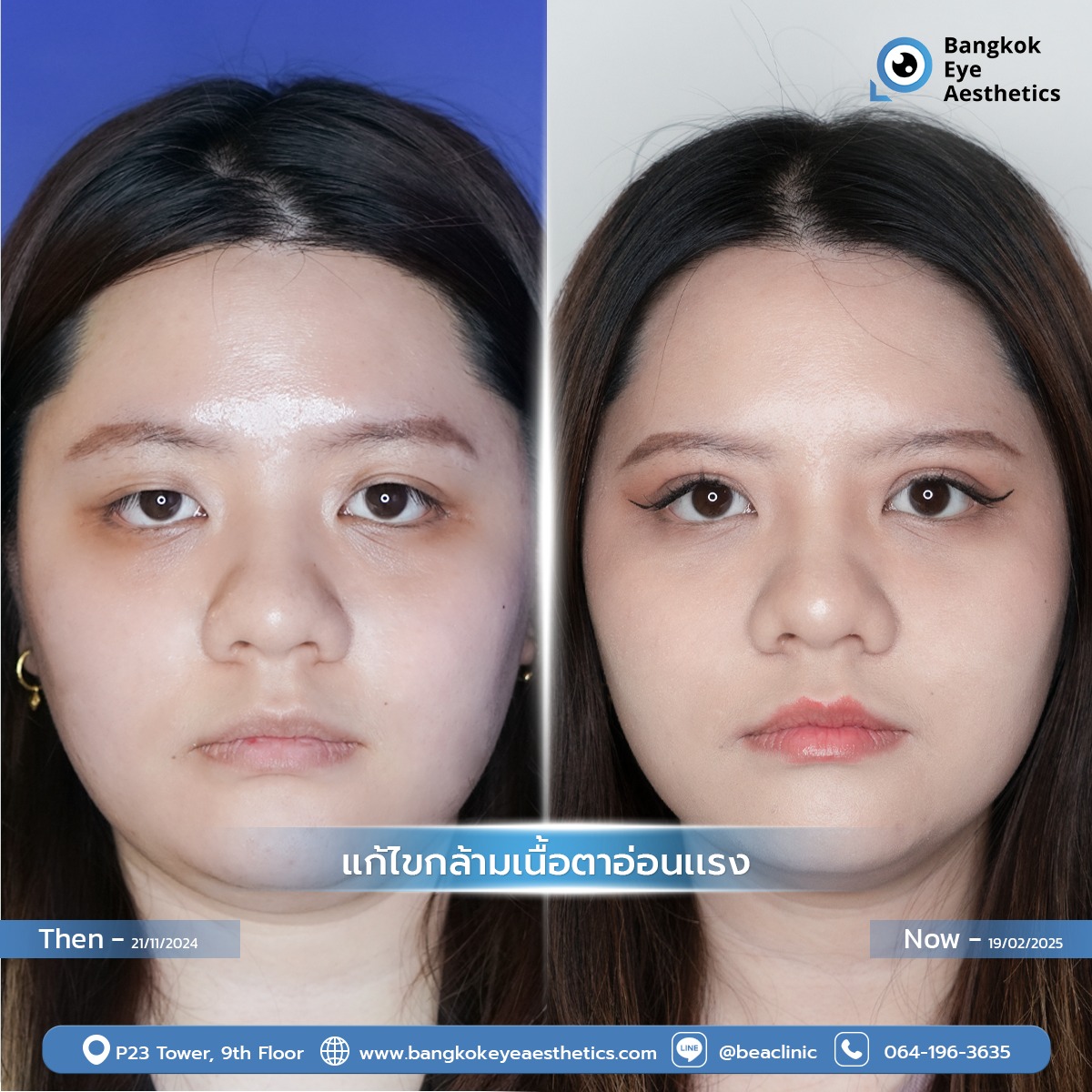 ผู้หญิงมีอาการกล้ามเนื้อตาอ่อนแรง 